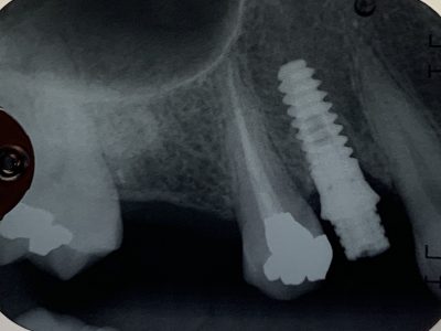 B856DE0C-C7E4-41EC-97B2-4C28E1049F7C Minimally Invasive Dental Implant Placement