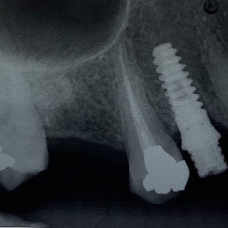 Minimally Invasive Dental Implant Placement