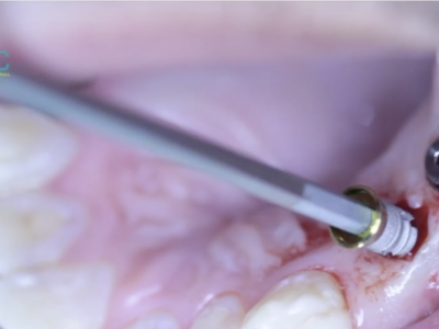 Screen-Shot-2019-11-07-at-9.41.31-AM BBX2 TISSUE LEVEL IMPLANT PLACEMENT PROTOCOL