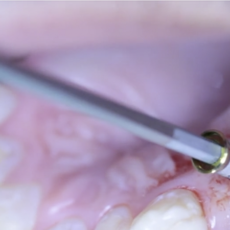 Screen-Shot-2019-11-07-at-9.41.31-AM BBX2 TISSUE LEVEL IMPLANT PLACEMENT PROTOCOL