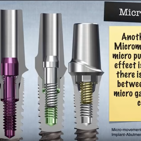 The Evolution of Implant Connections