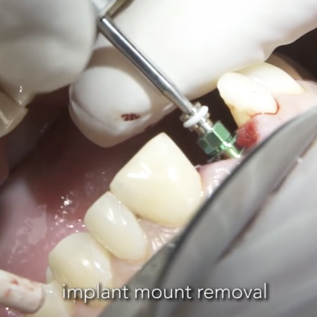 Screen-Shot-2020-02-24-at-6.01.32-PM Immediate implantation and loading of 11.Treatment of late post trauma external resorption of 11.