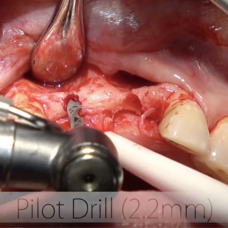 Screen-Shot-2020-02-24-at-6.15.06-PM BLT Implant Placement in anterior central incisors site with Guided Bone Regeneration
