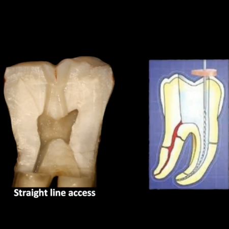 Screen-Shot-2020-02-26-at-6.26.58-PM Modern Endodontics: Rethinking Access and Instrumentation