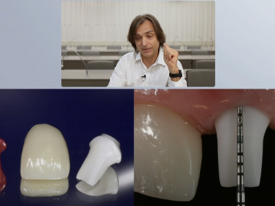 Screen-Shot-2020-05-08-at-1.40.13-AM Principles of Guided Bone Regeneration